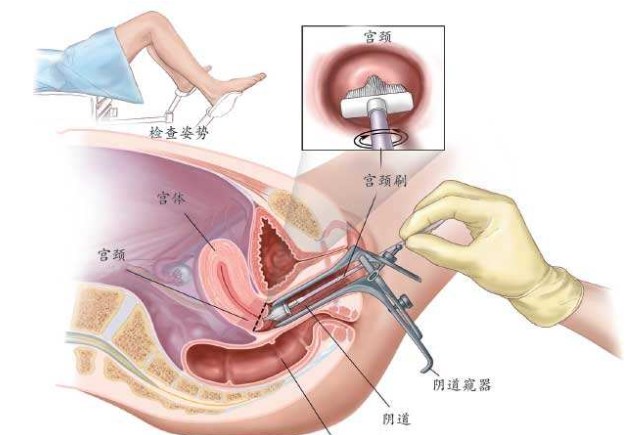 宮頸活體組織檢查