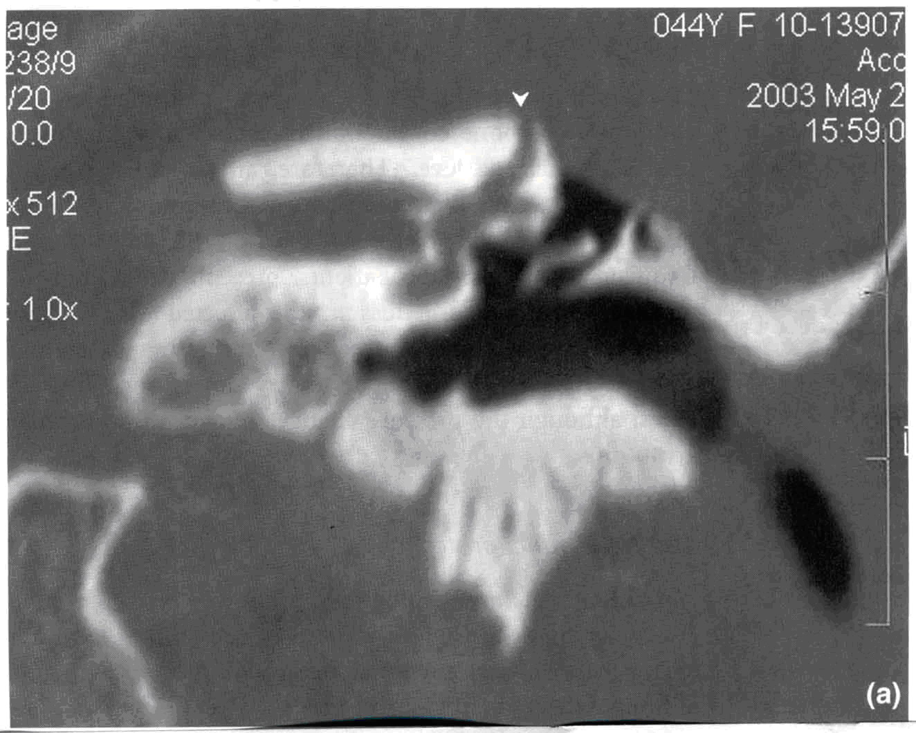 高分辨CT掃描(冠狀位)，顯示右側SSCD