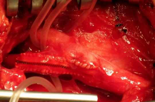 頸動脈內膜剝脫術