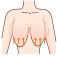 乳房下垂(胸部下垂)