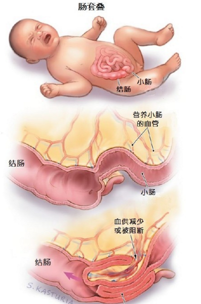 嬰幼兒灌腸法
